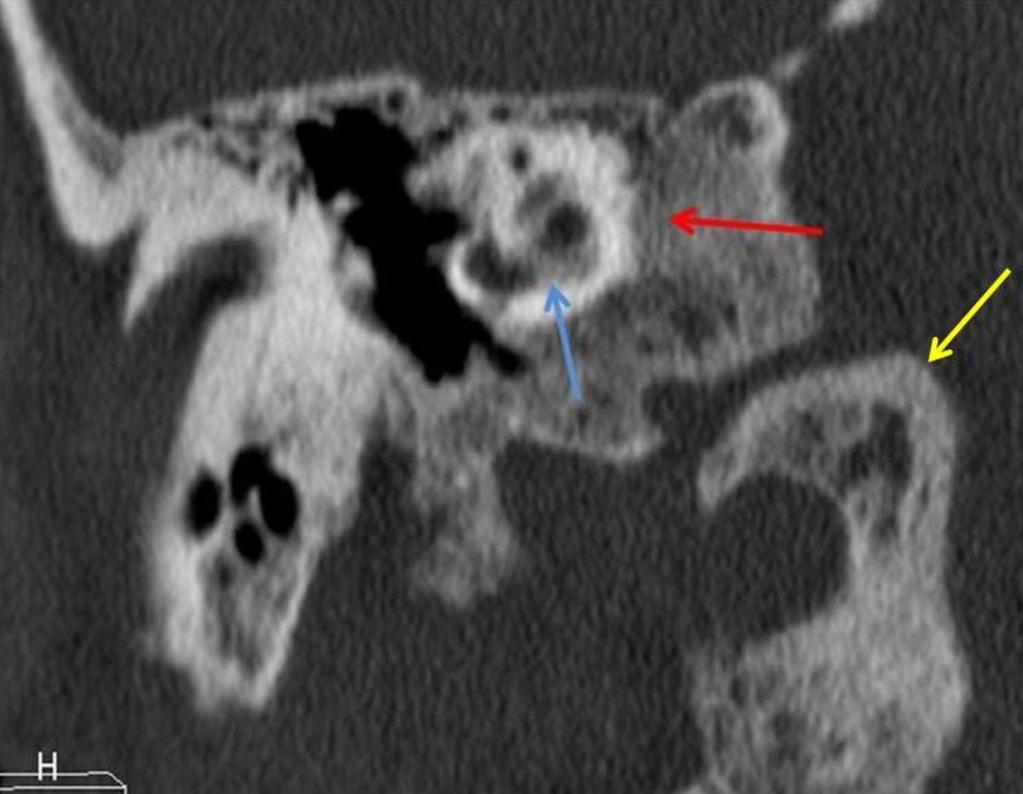 Fig. 7: Disminución de la densidad ósea que afecta la periferia de la cápsula ótica (flecha roja), así como la