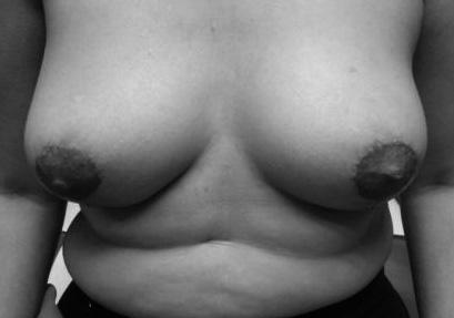 La exéresis del tejido mamario en el polo inferior más la reubicación del CAP le brinda a la mama un aspecto cónico con mayor proyección 31 (Fig 10).