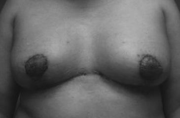 Figura 11. Técnica de Grisotti. Ésta paciente no quiso simetrización de la mama contralateral.
