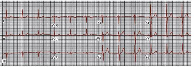 ELECTROCARDIOGRAMA El electrocardiograma (ECG), es un cálculo de diferencias de potencial diminutas sobre la superficie del cuerpo que reflejan la actividad eléctrica del corazón.