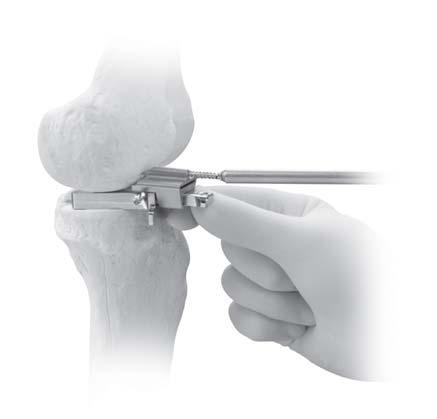 Así se garantiza que la resección femoral distal se practique en perpendicular al eje largo del fémur. Coloque el bloque de corte femoral distal en el mango del bloque espaciador (Figura 5).