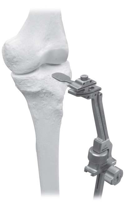 A la vez que aplica una tensión en valgo a la pierna, introduzca la pala del de corte femoral distal en el compartimento afectado (Figura 7).