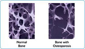 Osteoporosis: Alteracion esqueletica caracterizada por el compromiso de resistencia