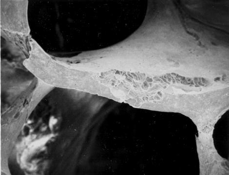 Osteoporosis: desequilibrio del turn-over
