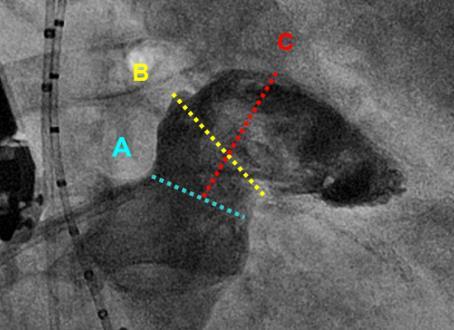 Mediciones y determinación de tamaño Las mediciones deben realizarse usando tanto la ecocardiografía como la angiografía Se puede usar un marcador flexible (pigtail) para el acceso a la OI y la
