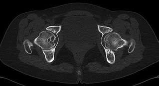 Radiografía panorámica de pelvis preoquirúrgica. HHS 41,8 en ambas caderas. B.