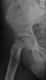Radiografías panorámicas de pelvis y perfil de cadera derecha en las que se objetiva epifisiolisis desplazada.