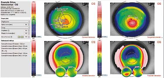 Figura 3. Módulo de cálculo de anillos intraestromales del topógrafo corneal Sirius en un paciente diagnosticado de queratocono (imagen cortesía de SCHWIND eye-tech-solutions GmbH & Co. KG, Germany).