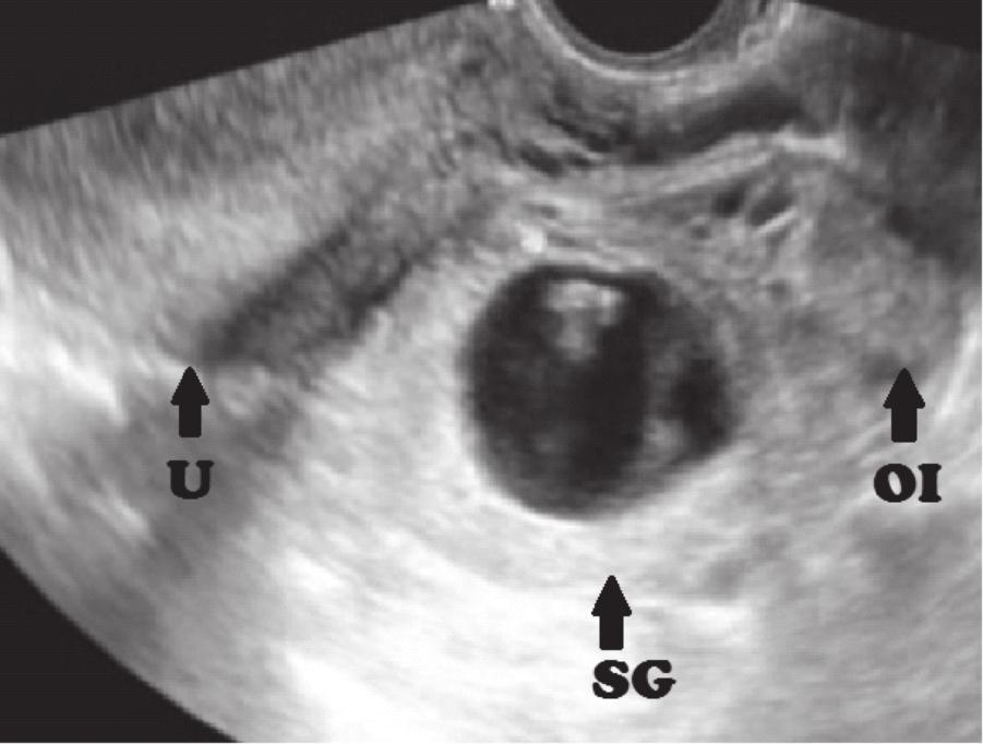 EMBARAZO ECTÓPICO GEMELAR DICIGÓTICO CON FETOS VIVOS Douglas una imagen descrita como embarazo gemelar bicorial biamniótico por la presencia de signos de Lambda (Figura 2), con longitud céfalo-caudal