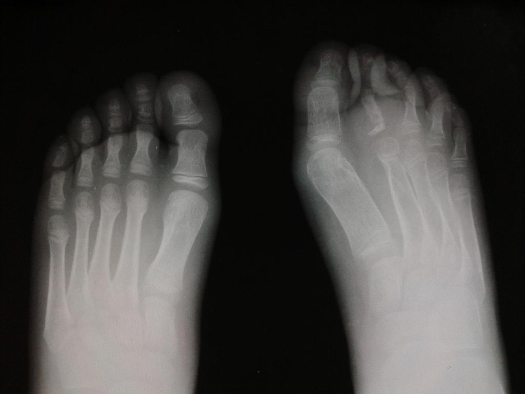 Fig. 3: Deformidad ósea extrínseca en el 2º dedo por la fibromatosis