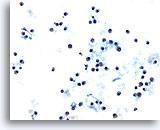 Figuras 35-36: Los linfocitos neoplásicos en estas dos fotos pueden parecer pequeños y
