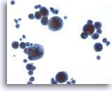 Figura 41 Melanoma maligno. Las células de un melanoma maligno pueden aparecen en derrames con o sin antecedentes de tumor en la piel.