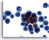Las células cancerígenas son fácilmente distinguibles de las células inflamatorias y de las células mesoteliales benignas.