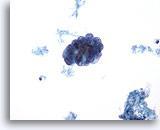 Un derrame peritoneal mostrando grupos de grandes células tumorales.