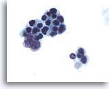 Las células tumorales son pequeñas e hipercromáticas, y deben ser diferenciadas de las células linfoides.