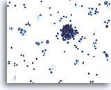 Observar el fondo necrótico. Figura 91 Carcinoma indiferenciado de célula pequeña, originario de pulmón.