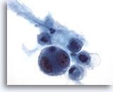 Las células malignas destacan fácilmente de las células benignas del