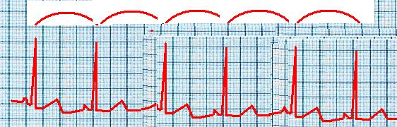 6 frecuencia cardiaca. Puede medir de 0.35 a 0.45, aunque cuando mide mas de 0,40 debe llamarnos la atención. CAUSAS DE QT corto: Digoxina, Hipercalcemia, Hiperpotasemia, Repolarización precoz.