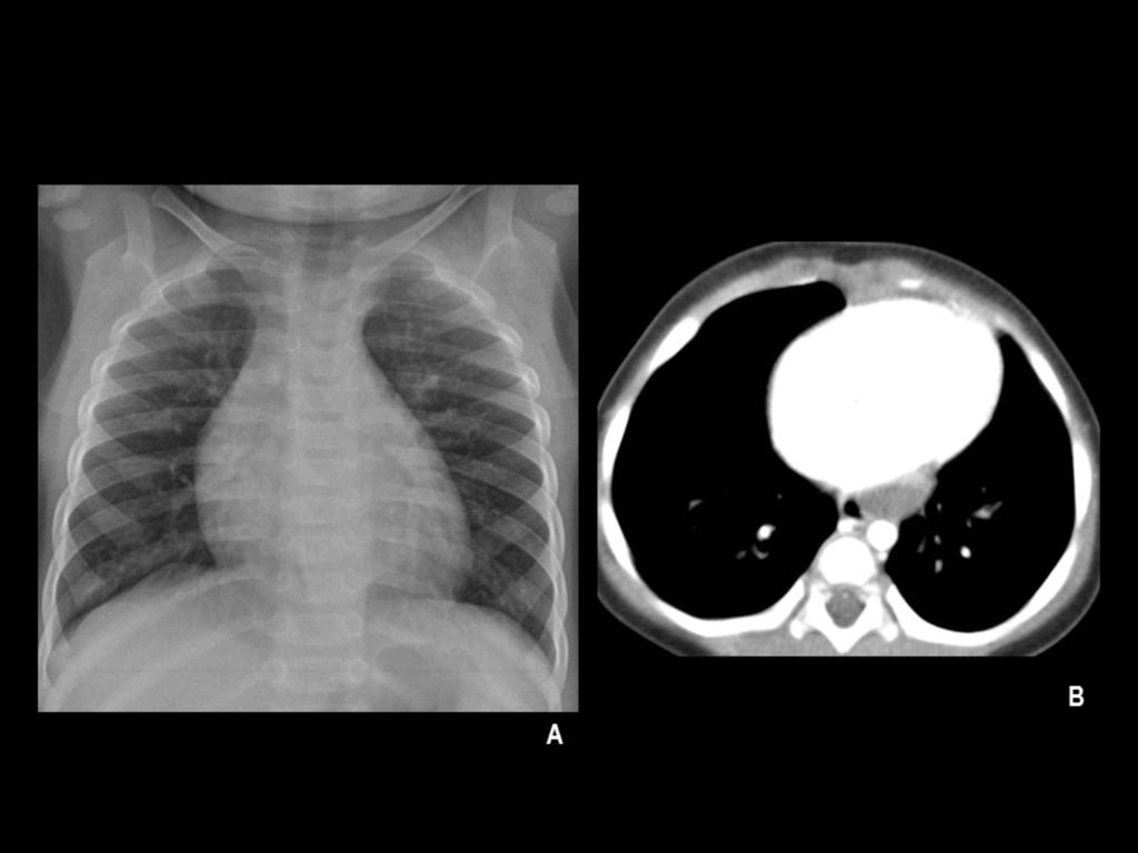Fig. 3: Niño de 1 año con sospecha clínico-epidemiológica de TB con RxT normal (A).