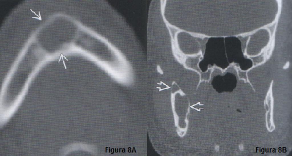 Fig. 8: Quiste óseo simple: -8A: La TC axial muestra un quiste óseo unilocular en la sínfisis mandibular con una corteza bien