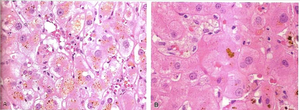 Morfologia de la colestasis Acumulación de pigmento biliar dentro del parénquima.