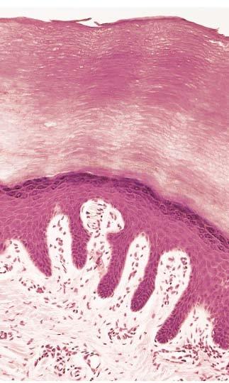 Estrato córneo ESTRATO CÓRNEO Células más diferenciadas de la epidermis. Pierden núcleo y organelas y se llenan completamente de filamentos de queratina.