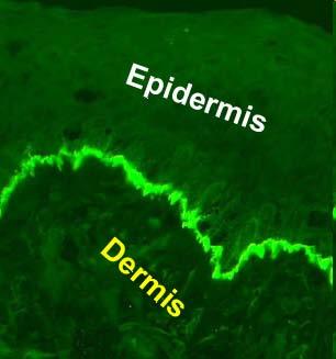 Dermis Es el tejido conjuntivo de la piel. Es un tejido conjuntivo laxo en su parte más superficial y denso no modelado o irregular en su parte más profunda.