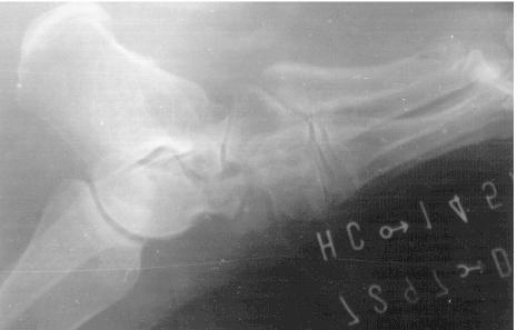 114 FIG. 3. Vista lateral del pie donde observamos la fragmentación de la prótesis de silastic al cabo de 16 años de uso.