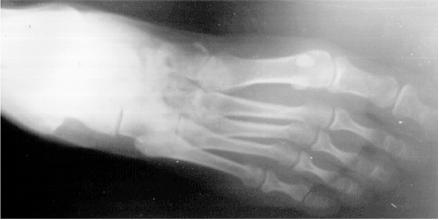 A prosthesis of radial cupula was used in the astragaloscaphoid articulation of the foot to replace the necrotic scaphoid that produced a lot of pain as a