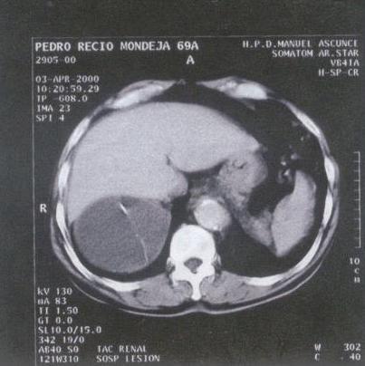 calcificados en la glándula adrenal derecha con el diagnóstico presuntivo de quiste de la glándula suprarrenal (Figura. 1).
