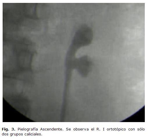 Se realiza cistoscopia encontrando dos orificios ureterales izquierdos, los que se cateterizan y se realiza