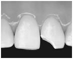 3M Restauración Clase IV Sistema Adhesivo Dental Single Bond de 3M Restaurador Universal Filtek Z250 de 3M Preparación del diente: