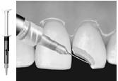 Bisele los márgenes del esmalte Grabado del diente: Aplique grabador Scotchbond de 3M al esmalte y la dentina; espere 15 segundos.