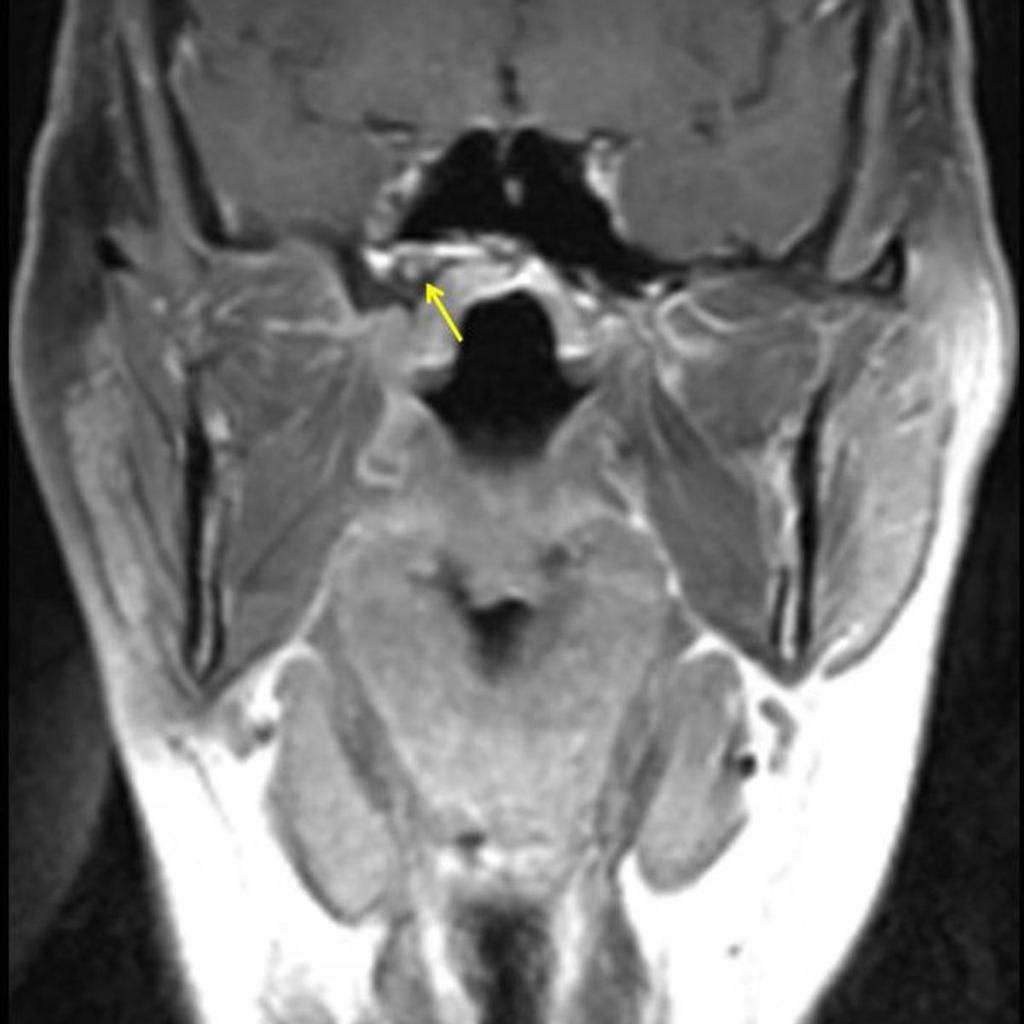 Fig. 3: Paciente con carcinoma adenoide quístico derivado de las glándulas salivares del paladar duro (mismo paciente que Figuras 1 y 2).