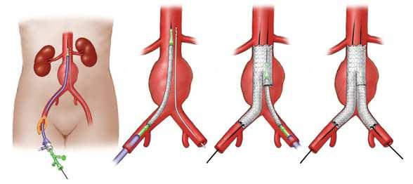 Introducción Aneurisma de Aorta Abdominal Dilatación de la aorta abdominal Puede llevar a ruptura