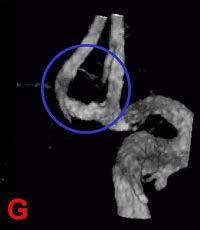 Figura G muestra el aneurisma completamente tratado (oscuro), con el resto de la vascularización normal.