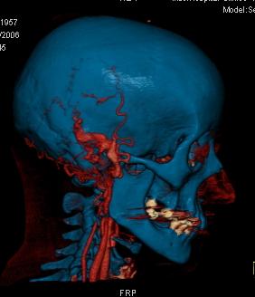 La importancia de la utilización de la técnica volumétrica VR de las imágenes en pacientes con prótesis ortopédicas, facilita evaluar de manera