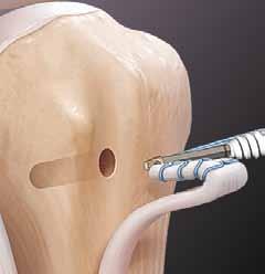Sistema SwiveLock Tenodesis - Técnica íntegramente artroscópica con punta bifurcada Los implantes de SwiveLock Tenodesis fueron diseñados para la tenodesis totalmente artroscópica del bíceps proximal.