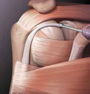 3 4 Dependiendo de las preferencias del cirujano, el tornillo SwiveLock Tenodesis se puede insertar dentro de la corredera bicipital o directamente superior a la inserción del pectoral mayor.