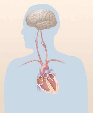 Qué es el síncope El corazón bombea sangre rica en oxígeno al cerebro y el resto del cuerpo. La frecuencia cardíaca y la presión arterial aumenta o disminuye según sea necesario.