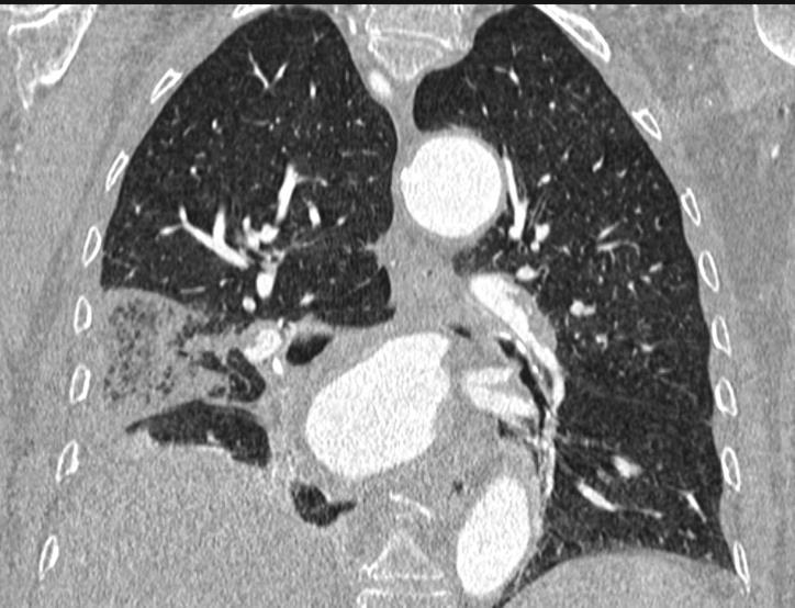 Introducción El angiotc de arterias pulmonares es la técnica de elección actual para el diagnóstico de tromboembolismo pulmonar agudo (TEP).