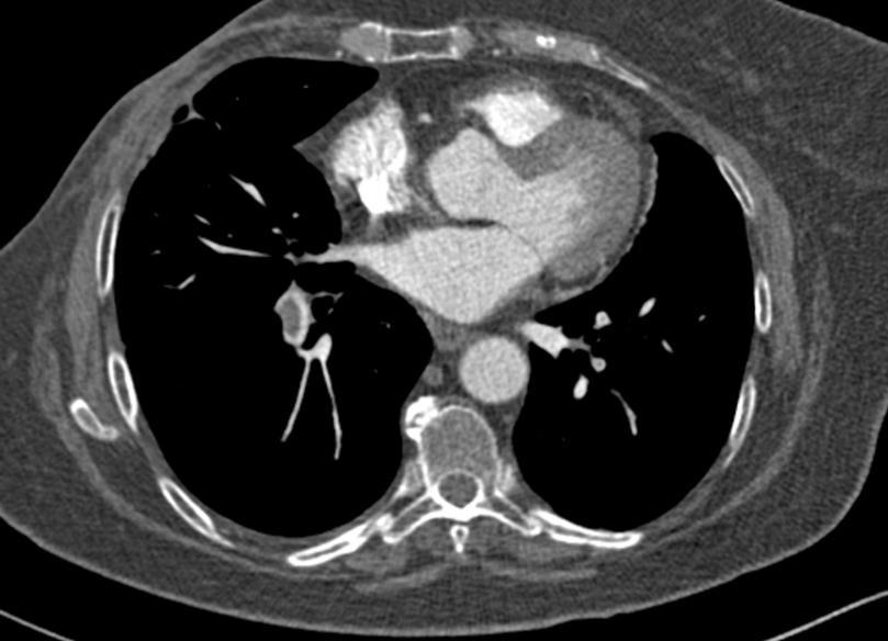También pueden aparecer alteraciones secundarias en el parénquima pulmonar como hemorragia o infartos.