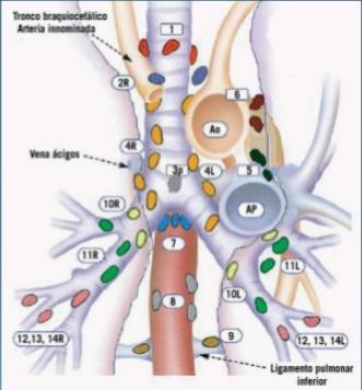Errores anatómicos Pitfall Ganglios linfáticos Venas pulmonares Moco bronquial Para evitarlo En imágenes secuenciales y en distintos planos se ven extraluminales,
