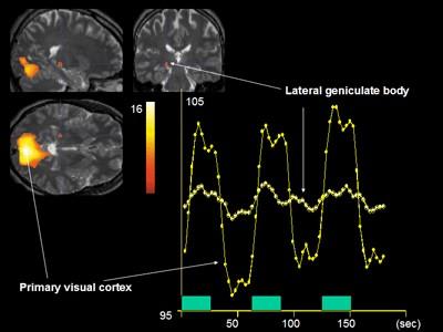 RM Funcional Mide la respuesta hemodinámica relacionada con actividad neuronal en el cerebro, es decir, permite detectar