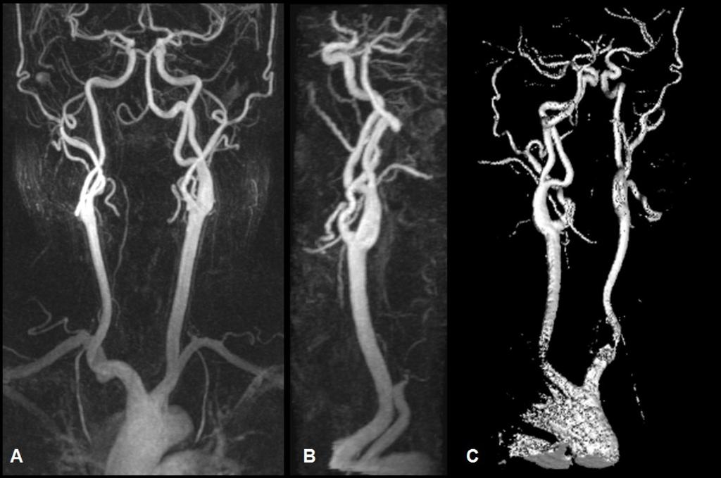 Fig. 14: A. Subvolumen MIP TOF 3D oblicuo coronal de la arteria basilar que muestra una gran ATP. Hipoplasia de la arteria vertebral PICA terminal. La a.