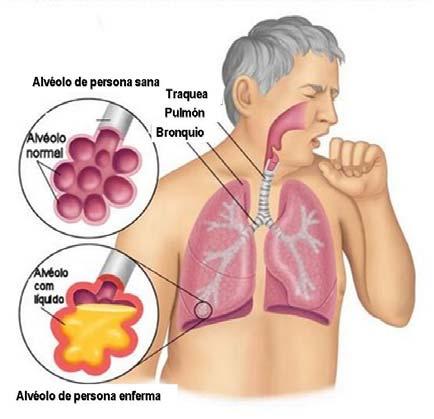 * La neumonía se transmite generalmente por contacto cercano con personas enfermas, cuando la persona sana inhala (respira) las gotitas de saliva de una persona enferma al toser o