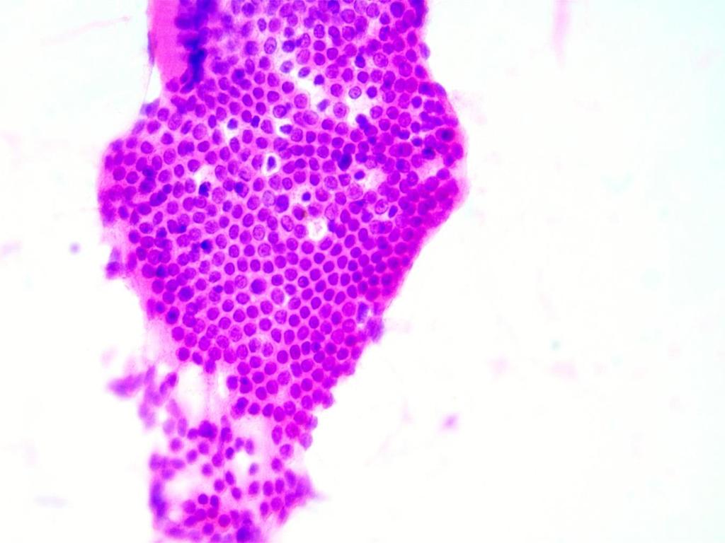Figura 1. Células ductales pancreaticas benignas.