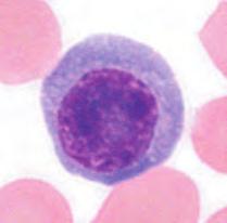 Casos de anormalidades en la línea de leucocitos Presencia de granulocitos inmaduros y linfocitos atípicos (2) leucemia células plasmáticas (PCL) Información del XS1000i Datos de análisis del XS1000i
