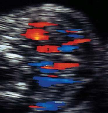 Doppler bocio fetal Doppler color Escala velocidad 13 cm/s