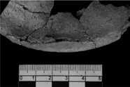 Fragmento de proyectil incrustado en cresta ilíaca Fig. 11.